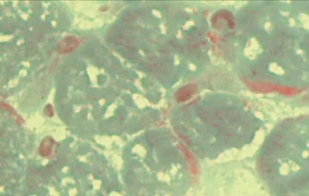 Mitokondriyal Hastalıklar-Kas patolojisi Gomori trikrom boyası: "Ragged red" lifler (RRF): genişlemiş ve anormal mitokondrilerin sarkolemma altında depolanarak kırmızı renkte
