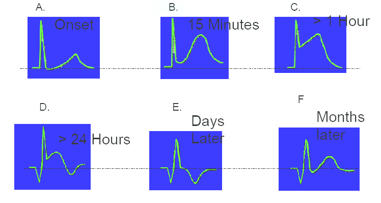 EKG