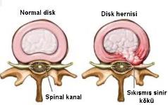 Cervikal Herniler (Boyun fıtıkları) Cervikal Herniler (Boyun fıtıkları) Boyun, vücudun en komplike eklem yapısı ve omurganın en hareketli parçası olup karotis ve vertebral arteri, omuriliği ve spinal