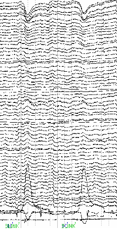 EEG Verisinde Ön-İşlemleme İşlemleri Şebeke ceryanından kaynaklanan artifaktların süzgeçlenmesi.