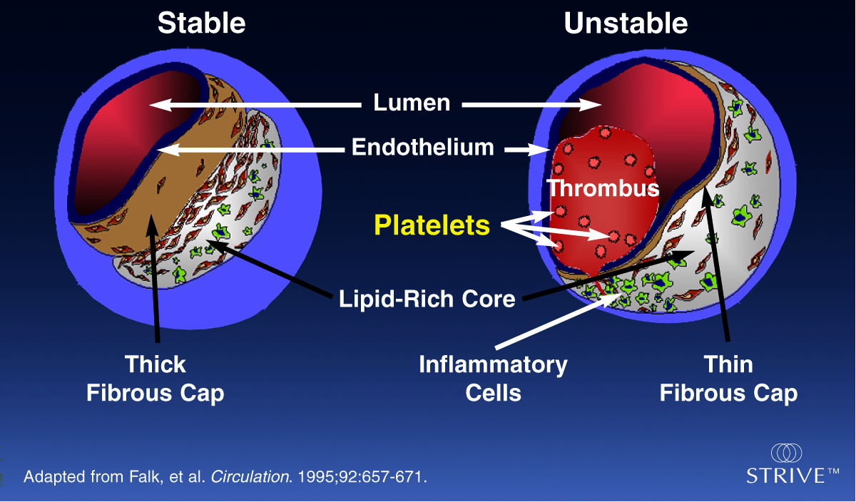 Aterotromboz: Aterosklerotik Plak Üzerine Gelişen Trombüs