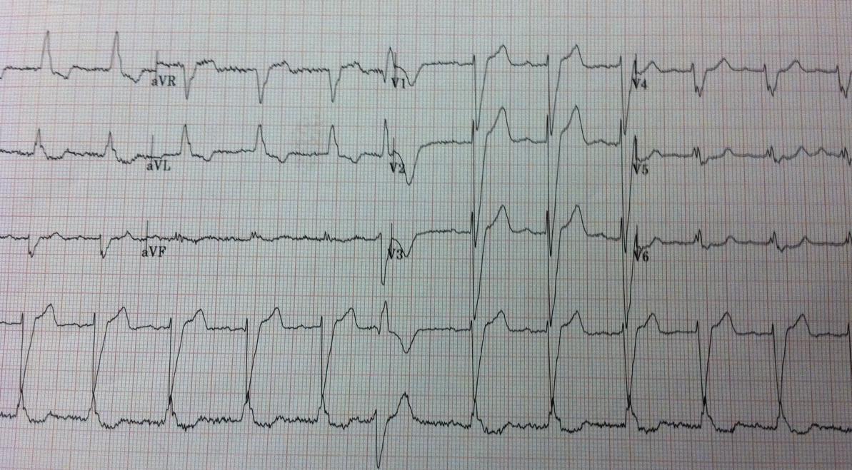 EKG