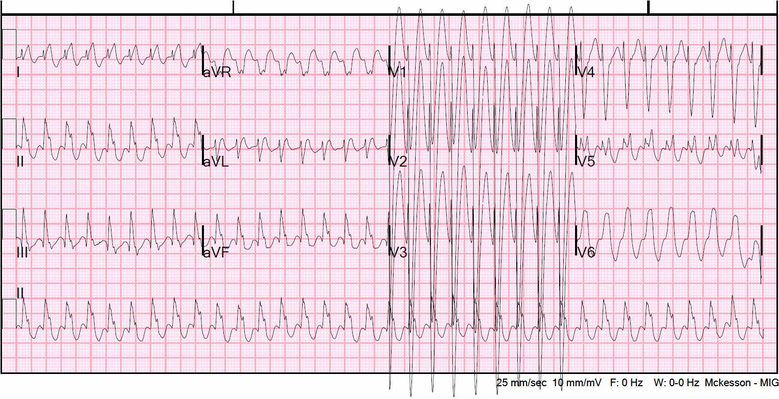 EKG