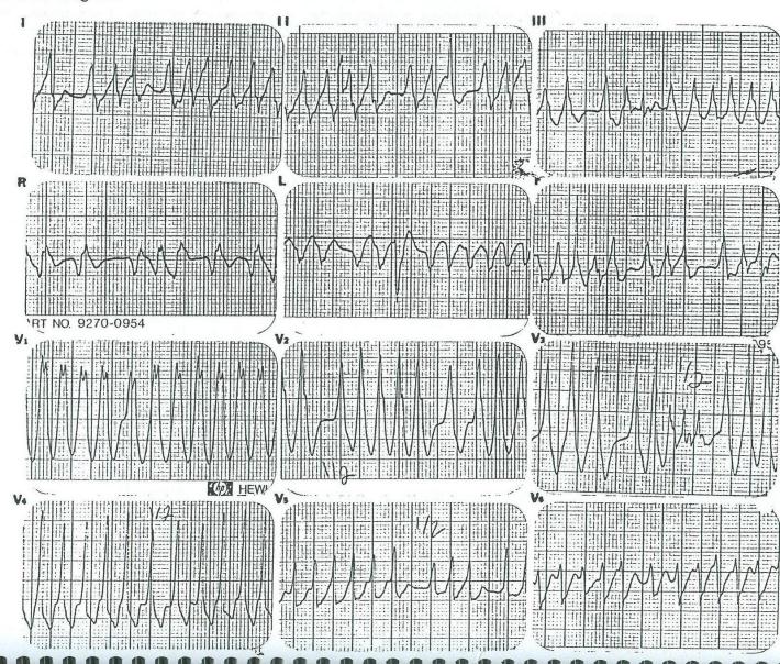 Vaka 11 Cevap Düzensiz ve morfolojileri farklı QRS, Multi fokal atriyal taşikardi veya AF, QRS geniş AF + LBBB veya RBBB veya nonspesifik intraventriküler iletim gecikmesi Fakat bu durumlarda çok