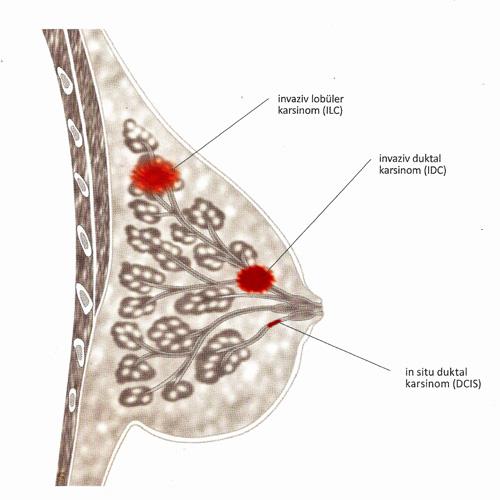 İnvaziv meme kanserleri: İnvaze duktal karsinom(idc): Süt kanallarında başlar ve yakınındaki tüm