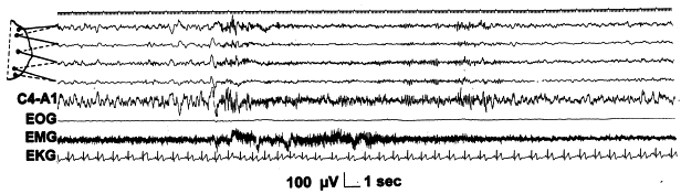Ani frekans şifti 7) EEG arousallar Teta, alfa ya da