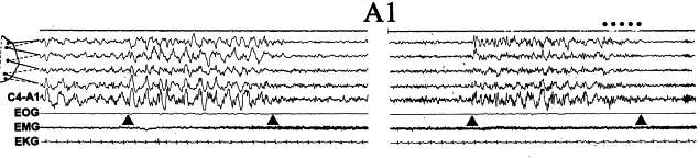 A1 alt tipi EEG senkronizasyonu temel aktivite Desenkron EEG % 20 nin altında Oluşturan yapılar Delta
