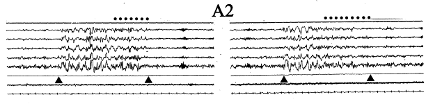 A2 alt tipi EEG aktivitesi yavaş ve hızlı ritim karışımı Desenkron EEG