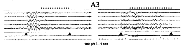 A3 alt tipi Temel aktivite düşük voltajlı hızlı ritim Desenkron EEG A fazının % 50 sinden fazlasını kapsar Oluşturan dalgalar