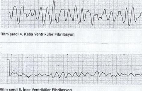 Elektrotun göğüs kafesi ile teması: Göğüs duvarının traş edilmesi: Göğsü kıllı olan hastalarda elektrot göğse tam yapışmayarak havada kalabilir.