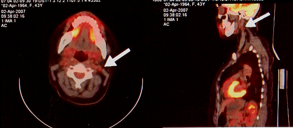 Resim 2d Resim 2d: Aynõ PET/BT görüntülerinde boyun sol üst tarafõnda üst juguler alanda