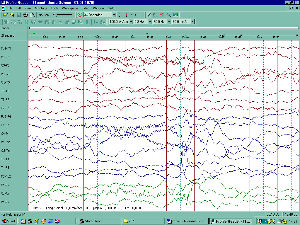 Şekil-7: K kompleksi İSTATİSTİKSEL ANALİZ Verilerin değerlendirilmesinde istatistiksel olarak Statistical Package for Social Sciences (SPSS 10.0) paket programından yararlanıldı.