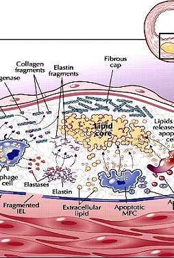 Fibröz kapsül olu..umu ile lipid çekirdek, fiziksel olarak endotelyal yüzeyden ayr"lm".t"r ve plak stabilize olmu.tur; ancak bunun bedeli arter lümeninin daralmas"d"r. Olu.