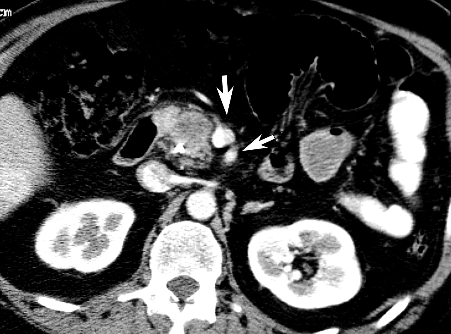 Retroperitoneal