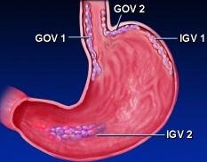 Gastrik Varisler Portal hipertansiyonun bütün tiplerinde ilk endoskopik taramada %20 oranında bulunur (primer) Özofagus varislerinin eradike edilmesi sonrası ilk 2 yıl içerisinde %10 olguda daha