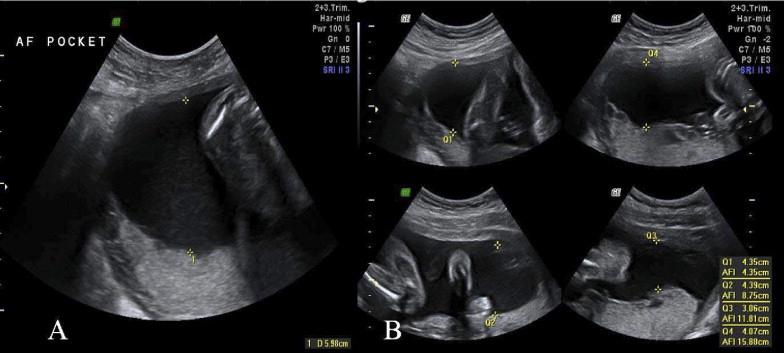 TRANSABDOMİNAL AMNİYOİNFÜZYON 24 hafta