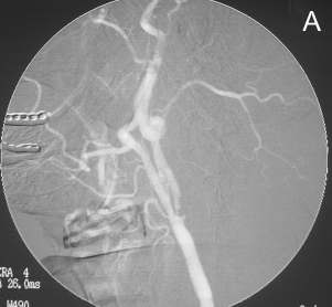 Şekil 1 C-E. Sağ ICA başlangıç kesimindeki stenoz da (C) residüel stenoz kalmayacak şekilde tedavi edilmiştir (D). E de sağ internal karotis arterdeki stentin power Doppler incelemesi yer almaktadır.