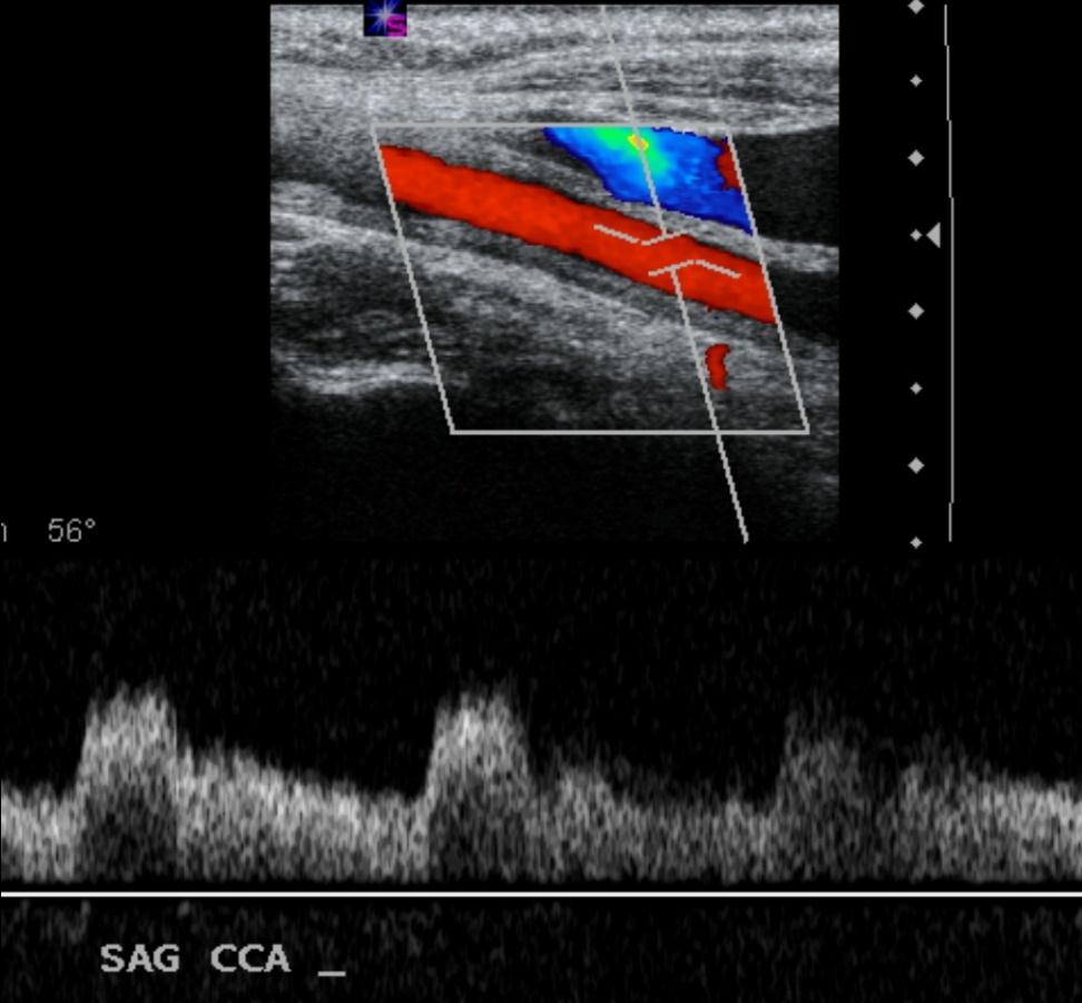 Karotis Arter Doppler US Hemodinamik