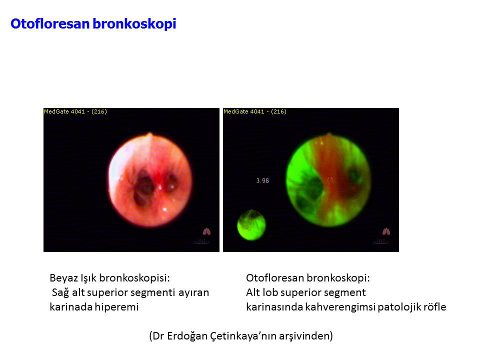 Akciğer Kanserinde Tanı ve Evreleme Teknikleri (FOB, Otofloresan bronkoskopi EBUS, EUS) Resim 2. Sağ alt lob süperior segment karinasının otofloresan bronkoskopi görüntüsü.