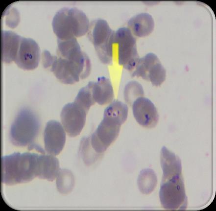 Tanı Kalın damla Çok sayıda halka şeklinde trofozoitler İnce damla Eritrosit hücresi içerisinde çok sayıda halka