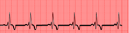 46 2.12.1 R dalgası Sol ventrikül depolarizasyonunu gösterir. QRS in ilk pozitif dalgasıdır. 2.12.2 S dalgası Sağ ventrikül depolarizasyonunu gösterir. R dalgasını izleyen ilk negatif dalgadır.