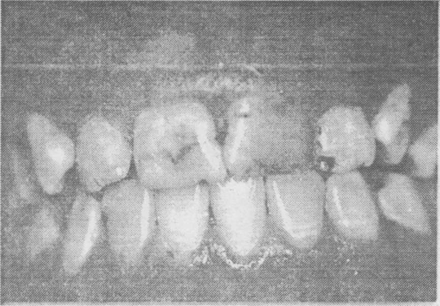 (Resim 1) Hastanın ağız hijyeni ve periodontal sağlığı iyi durumdaydı ve class t okluzyon mevcuttu.