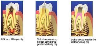 1. Sağlıklı Diş 2. Mine Çürüğü Dolgu 3.