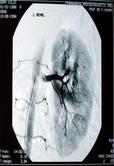 VASKÜLİTLER-Poliarteritis nodosa 9