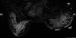 Olgu 8: Osteoklast tipi dev hücreli meme karsinomu (34 y). Resim 10: Sağda tüm meme parankimini içeren sertlik, meme başında çökme ve fiksasyon izlendi.