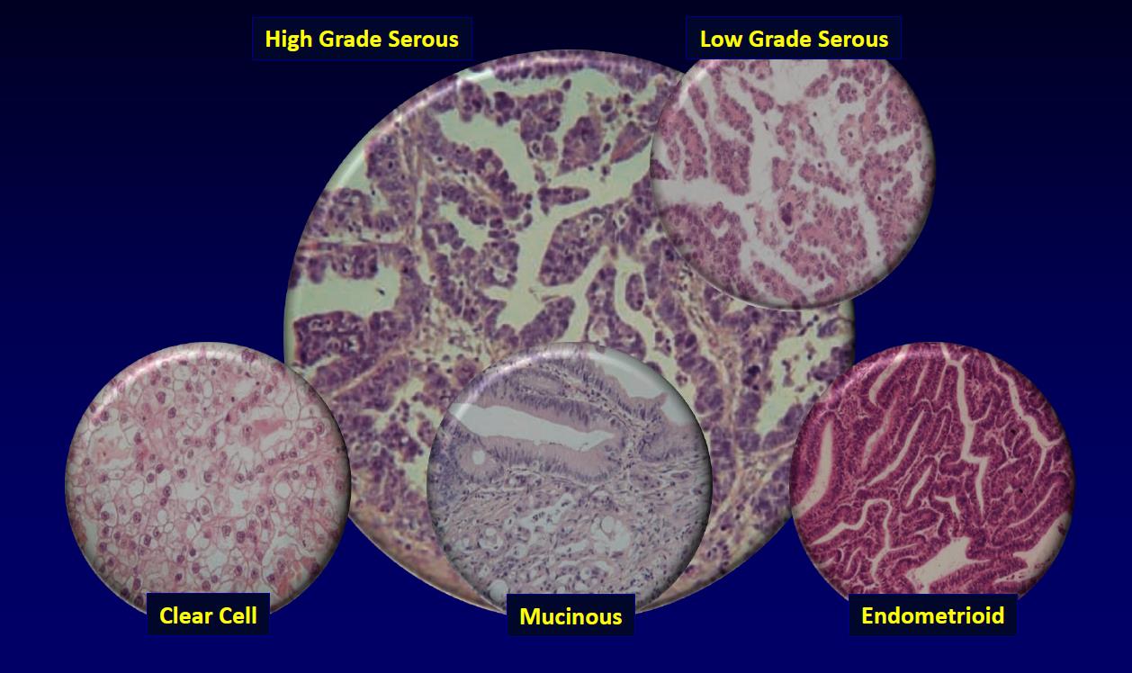 Ovarian Kanser - Histopatolojik Tipler High