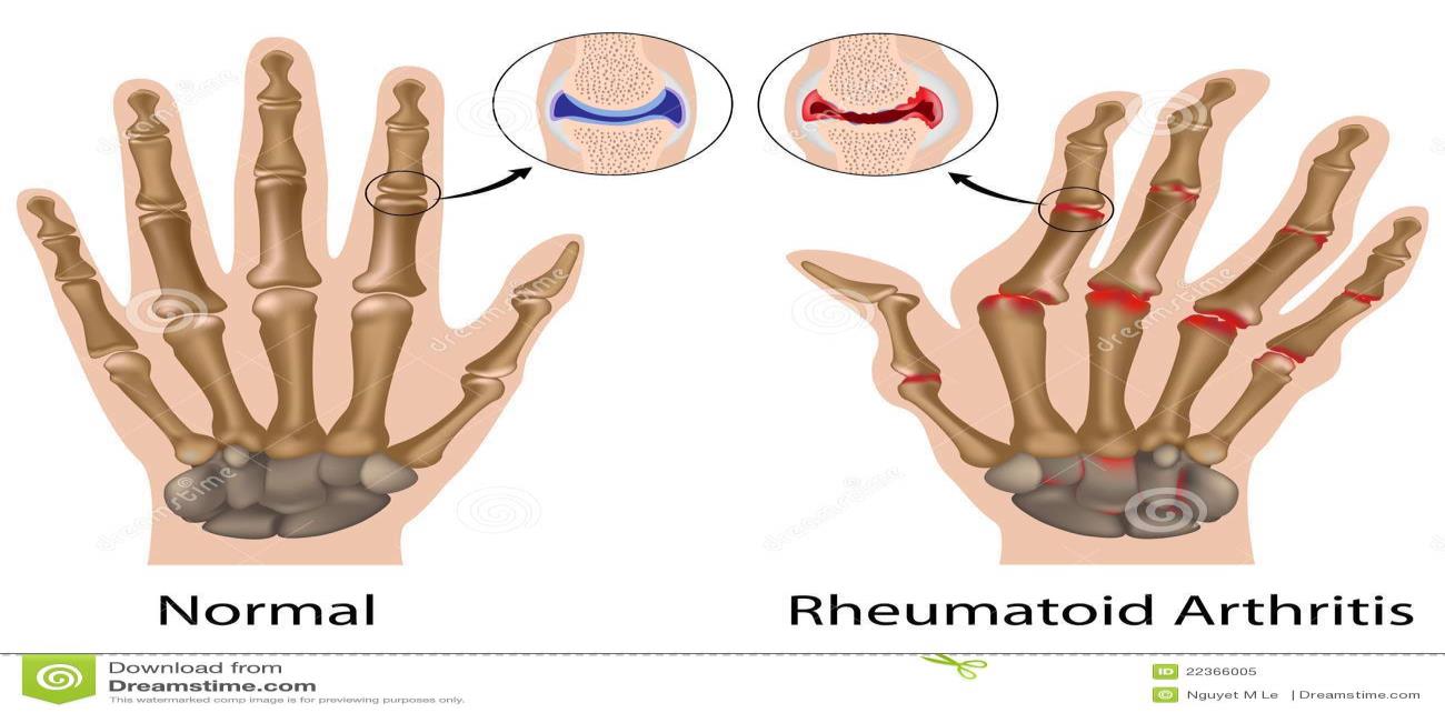 Scholtysek et al., 2012.