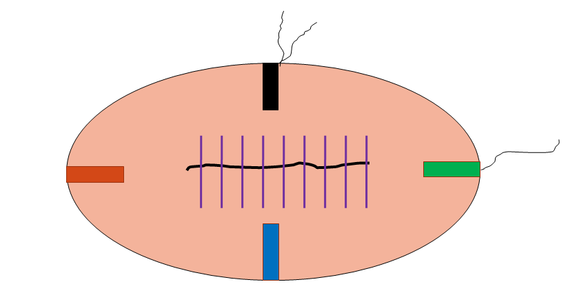 VI F: Reeksizyon materyalleri Genellikle eksizyonel biyopside cerrahi sınırın pozitif olduğu saptanan lezyonlarda sınır genişletmek amacıyla yapılır. Cerrahi sınırlar boyanır.