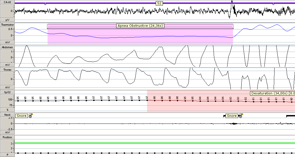 Obstrüktif Apne Apne Sonucu Gelişen Arousal