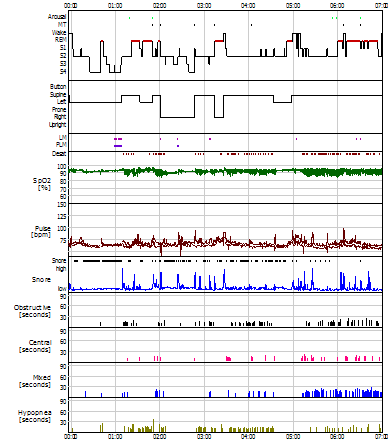 OUAHS (Tipik Testere Dişi