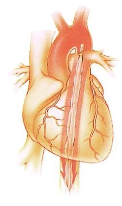 Diastol esnasında Sistol esnasında Diastol esnasında balon şişirilerek aort içindeki kanın koroner arterlere yollanması sağlanır, böylece koroner arterlerden oksijence zengin kan akışı olur ve kalp