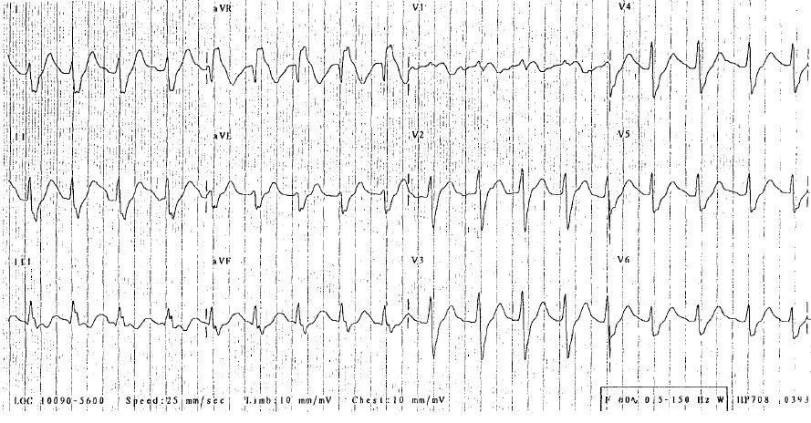 EK BULGULAR ELDE ETME ÇABASI 6 mm avr