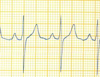 EKG de hız saptanması 300 / 3 = 100 1500 / 15 =100 Normal hız 60-100/dk >100/dk taģikardi < 60/dk Bradikardi