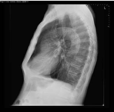 Basit bir lateral göğüs/abdominal röntgen aortik kalsifikasyonun şiddetini gösterebilir: Kalsifikasyon yok Orta şiddette