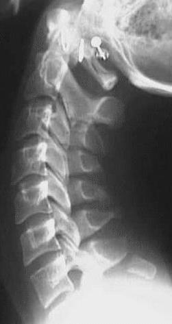 VERTEBRA YARALANMALARI Minör Tek bir kolona nafiz