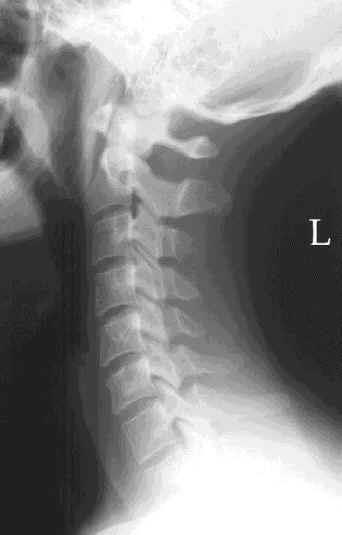 1. Anterior vertebral hat Anterior kolon 1 2 