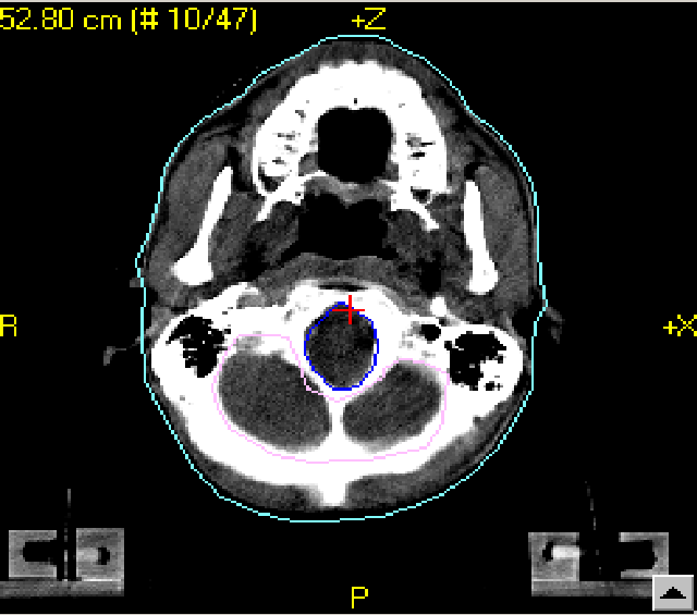 Planlama - Tedavi Süreci Konturlama Birçok kritik organın belirlenmesi radyasyon