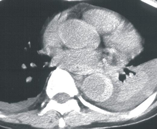 A) Medyastinal hematom B) İntramural