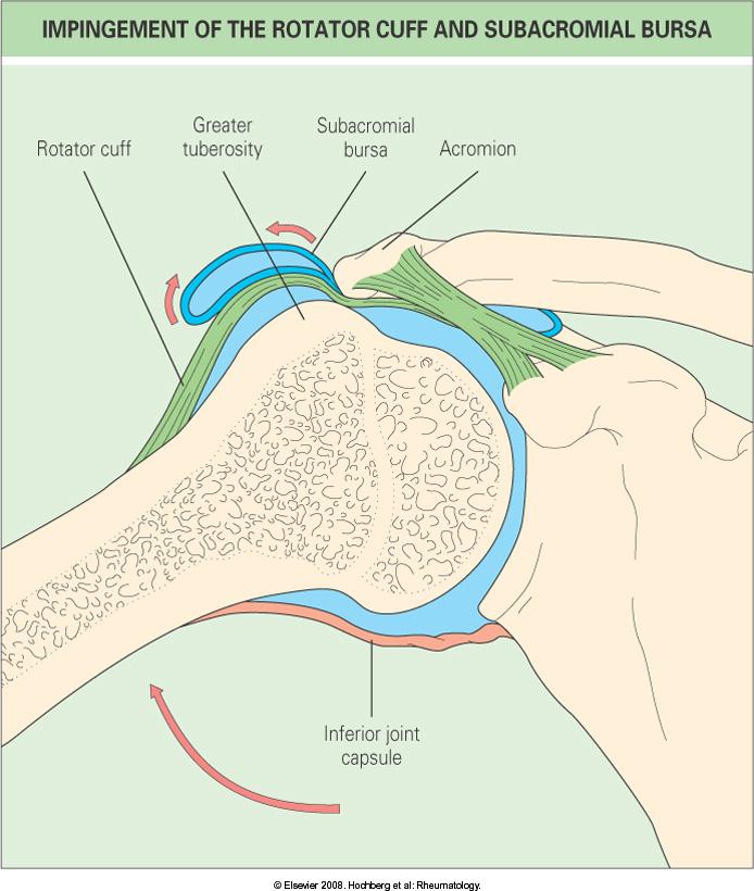 Subakromiyal ağrılı omuz sorunları sıkışma / impingement Rotator kaf tendiniti ve/veya bursiti 40 y< yüksek prevalans Rotator kaf rüptürü 60 y< % 20-30 parsiyel / tam kat