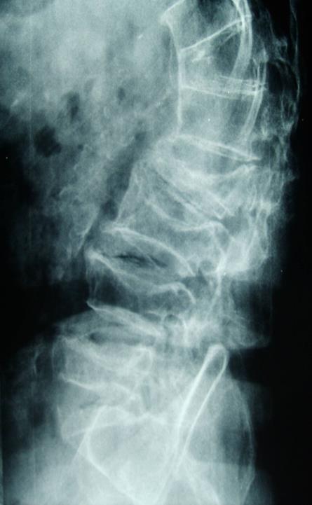 Konvansiyonel Radyografi Sessiz vertebral kırıklar gözden kaçabilir.