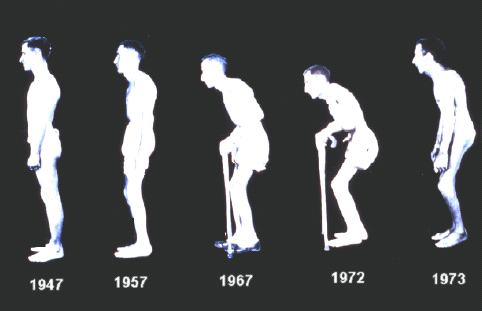 Ankilozan Spondilit (AS) 1. Progressif Hastalık; İnflamasyon Osteoproliferatif Osteodestrüktif değişiklikler 2. Kronik Semptomlar; Ağrı Sabah tutukluğu Yorgunluk 3.