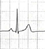 TAŞİKARDİ Dar QRS li ( 0.