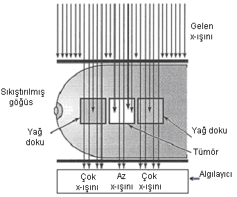 Şekil 3.1: X-ışınının yağlı dokudan geçtikten sonra bez dokudan geçen ışınlara göre daha fazla ölçülmesi. ([6], Şek.1-1) Bez doku oranı fazla memelere yoğun meme denir.