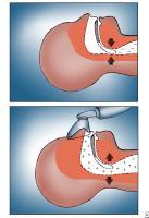 CPAP Etki Mekanizması CPAP tedavisi hava