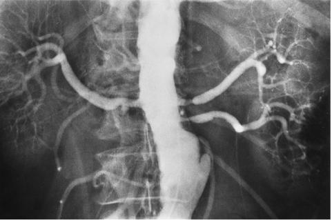 Renal arter stenozu Anatomik bir tanı Asemptomatik