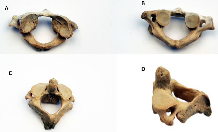 Os Hyoideum (Hiyoid Kemik) Mandibula'nın alt tarafında bulunan ve U harfine benzeyen bir kemiktir. Herhangi bir kemikle bağlantısı yoktur.